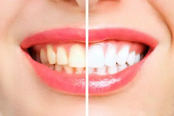 Understand the science behind teeth whitening Gosport